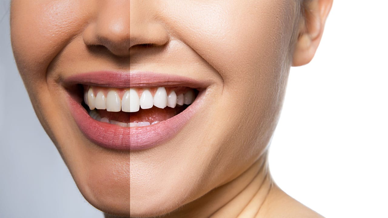 Teeth Whitening Lockport